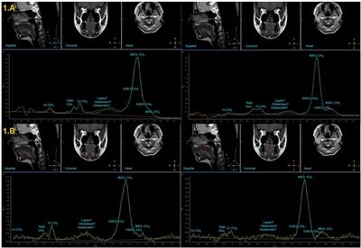 Evaluation of Proton MR Spectroscopy for the Study of the Tongue Tissue in Healthy Subjects and Patients With Tongue Squamous Cell Carcinoma: Preliminary Findings